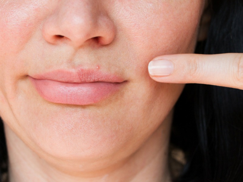 Як уникнути появи прищів на губах