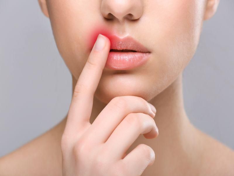 Як уникнути появи прищів на губах